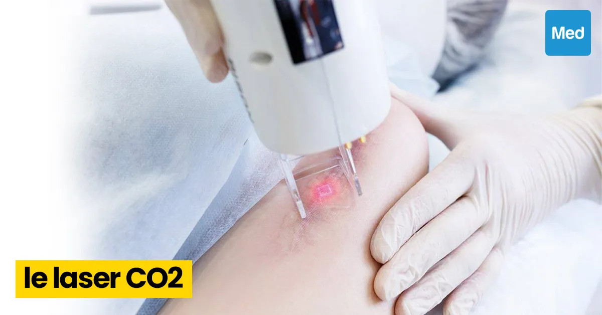 Laser CO2 pour les taches pigmentaires et les cicatrices d’acné